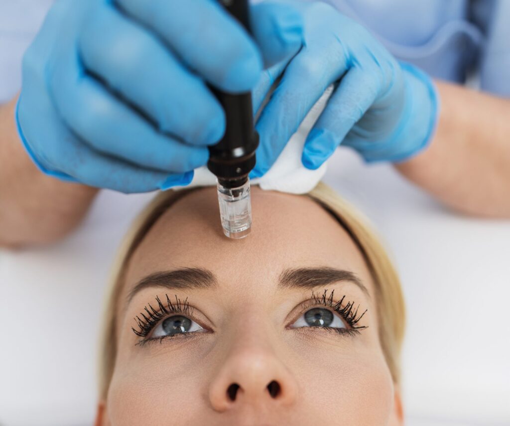 Microneedling